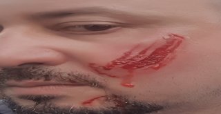 Borçlu İcra Takibi Yapan Avukatın Yanağını Isırarak Kopardı