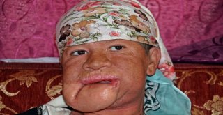 Çenesinde Çıkan Sivilceyi Önemsemedi, Hayatı Karardı