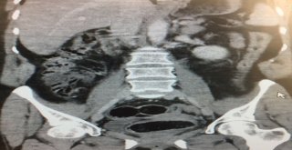 Rus Uyruklu Kadının Midesinden 7 Paket Uyuşturucu Çıktı